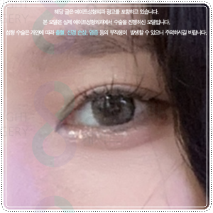연예인 쌍꺼풀 종류? 평균 쌍커풀 수술비용 차이는 왜 나나요? 관련 이미지 2