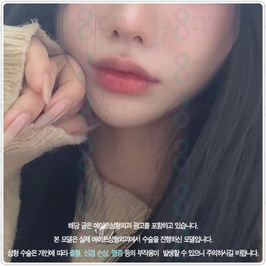 What Is the Difference Between 100 Shots and 300 Shots of Ulthera? Let’s Also Look at Ultherapy Prime Pricing and When Lifting Effects Appear image 1
