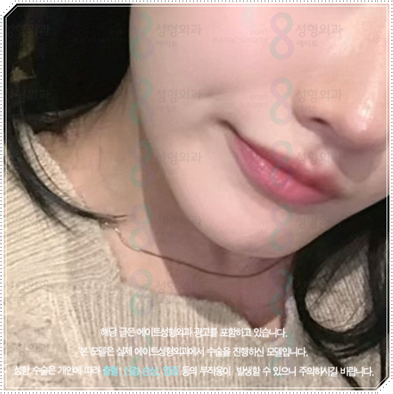 울쎄라피프라임 효과 얼마나 갈까? 300샷 통증과 후기, 가격까지 관련 이미지 2