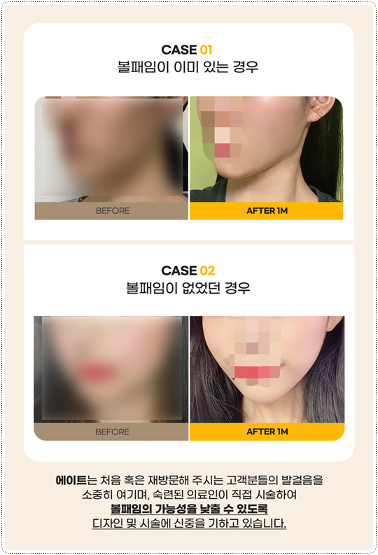 Ultherapy Lifting with 300 Shots: What Are the Price and Before-and-After Changes You Should Know Before the Procedure? image 10