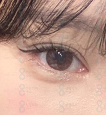 강남 눈매교정잘하는곳 비절개눈매교정전후 가격 차이에 대해서 관련 이미지 4