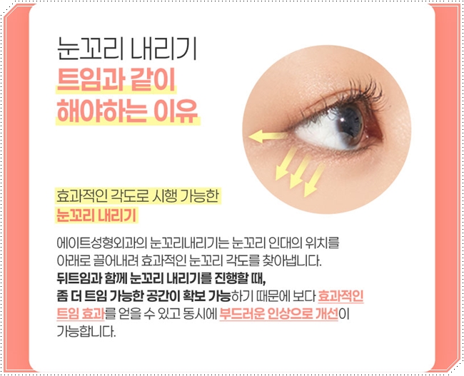 내 눈에 맞는 앞트임 필요할까? 수술 방법과 대략적인 비용 안내 관련 이미지 13