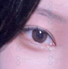 Eyelid Correction Surgery Review: Famous Eyelid Correction Clinic, Ptosis Surgery Before and After image 4