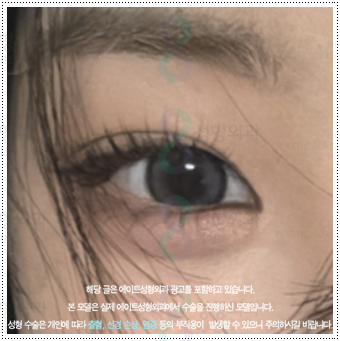 What Are the Prices and Combined Effects of Epicanthoplasty and Upper Epicanthoplasty with Double Eyelid Surgery? From Eye Shape Changes in Reviews of Front-and-Upper Epicanthoplasty to the Differences image 2
