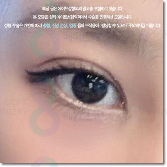 쌍수 가격은 평균적으로 얼마일까요? 매몰과 비절개? 절개 차이점까지 관련 이미지 2