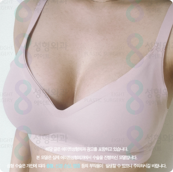 Apgujeong Plastic Surgery Clinics: Sharing Information on Breast Augmentation and Motiva Surgery image 4
