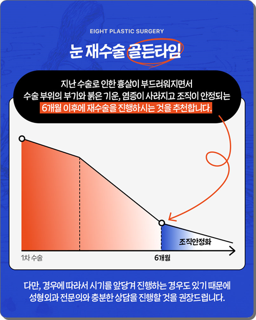 실패 없는 쌍꺼풀 재수술을 위해: 매몰법 특징부터 비용, 시기별 붓기 회복 과정 관련 이미지 6