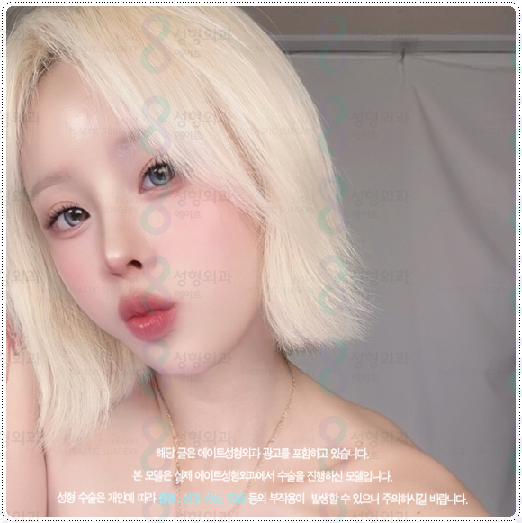 복코성형 콧볼축소 1개월 차! 코성형 붓기 빨리 빼는법과 코끝수술 후기 찾으셨나요? 관련 이미지 4