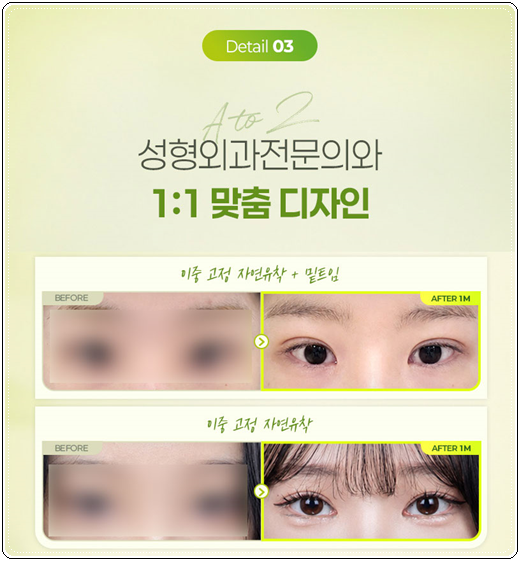 세미아웃라인 쌍수를 매몰로 하는법? 발품 비용 상담 후기 참고용 관련 이미지 13