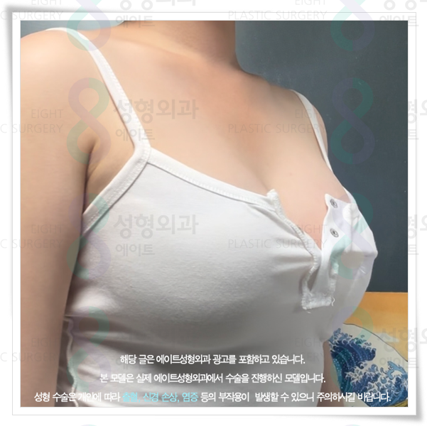 가슴성형 시 사용되는 보형물 종류와 가격 차이는 왜 생기나요? 관련 이미지 5