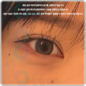 자연유착 매몰, 절개 차이 비교해봐요. 풀림 걱정없이 눈성형 비용과 후기 참고하는법 관련 이미지 5