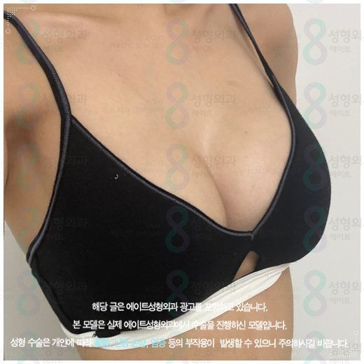 처진가슴 리프팅 수술, 출산후 수유후, 가슴 올리기, 보형물로 가능한가요? 관련 이미지 4