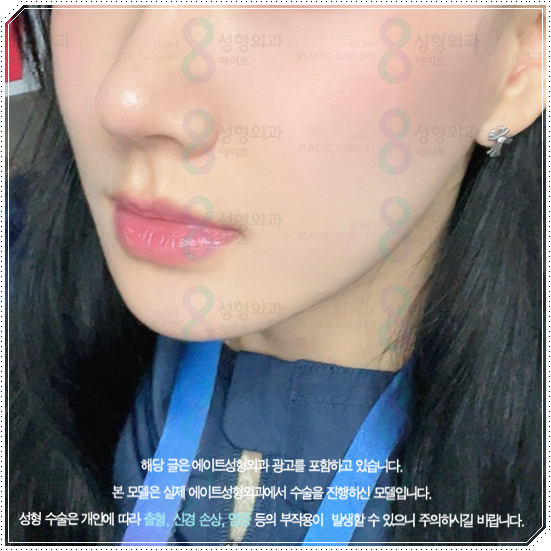 울쎄라피프라임 효과 얼마나 갈까? 300샷 통증과 후기, 가격까지 관련 이미지 3