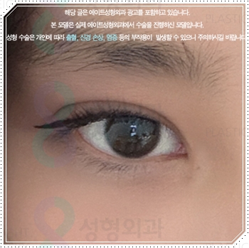 내 눈에 맞는 앞트임 필요할까? 수술 방법과 대략적인 비용 안내 관련 이미지 4