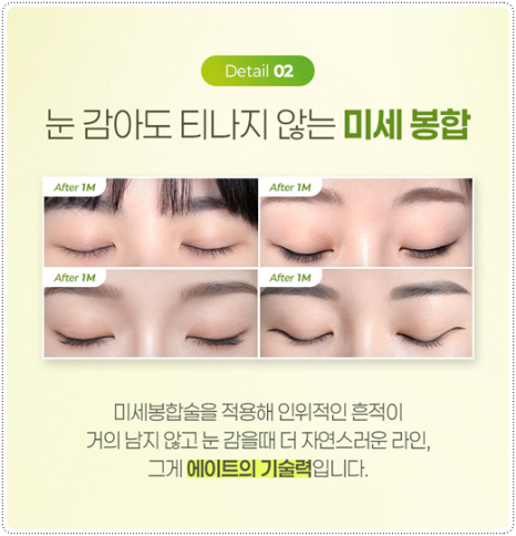 Natural Double Eyelid Surgery Using the Non-Incisional Method: A Budget and Consultation Guide for Middle School Students’ Eye Shapes Before and After Surgery image 12