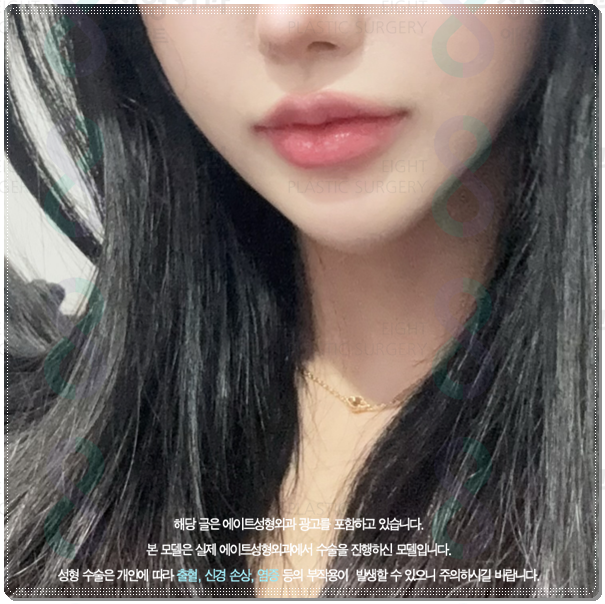 울쎄라 턱살에 효과 언제부터 있나요? (300샷 기준의 가격 평균은?) 관련 이미지 4