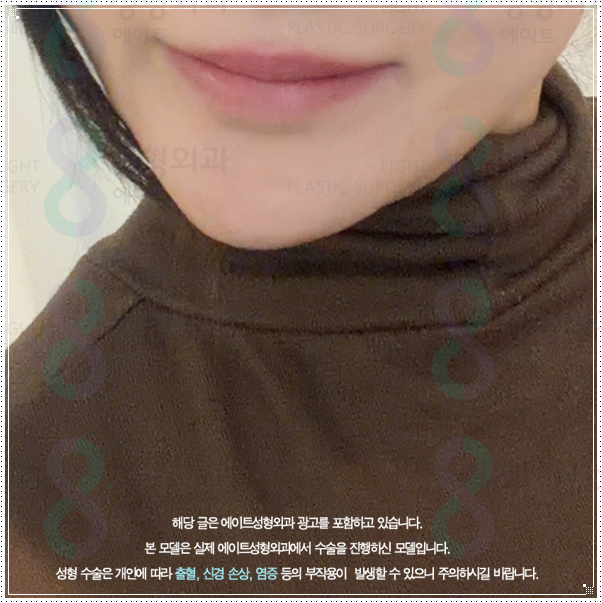 처지는 피부 고민? 리프팅 중 울쎄라 100샷은 300샷과 가격이나 효과가 많이 다른가요? (울쎄라피프라임) 관련 이미지 5