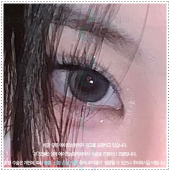 What Are the Prices and Combined Effects of Epicanthoplasty and Upper Epicanthoplasty with Double Eyelid Surgery? From Eye Shape Changes in Reviews of Front-and-Upper Epicanthoplasty to the Differences image 1