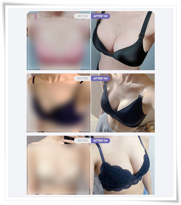 가슴성형 시 사용되는 보형물 종류와 가격 차이는 왜 생기나요? 관련 이미지 10