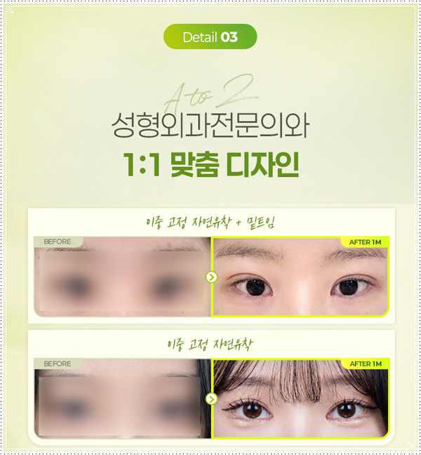 인라인 쌍꺼풀 후기, 쌍수 전과 1개월 후 라인은 어떻게 달라질까 관련 이미지 13