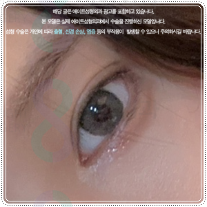 연예인 쌍꺼풀 종류? 평균 쌍커풀 수술비용 차이는 왜 나나요? 관련 이미지 1