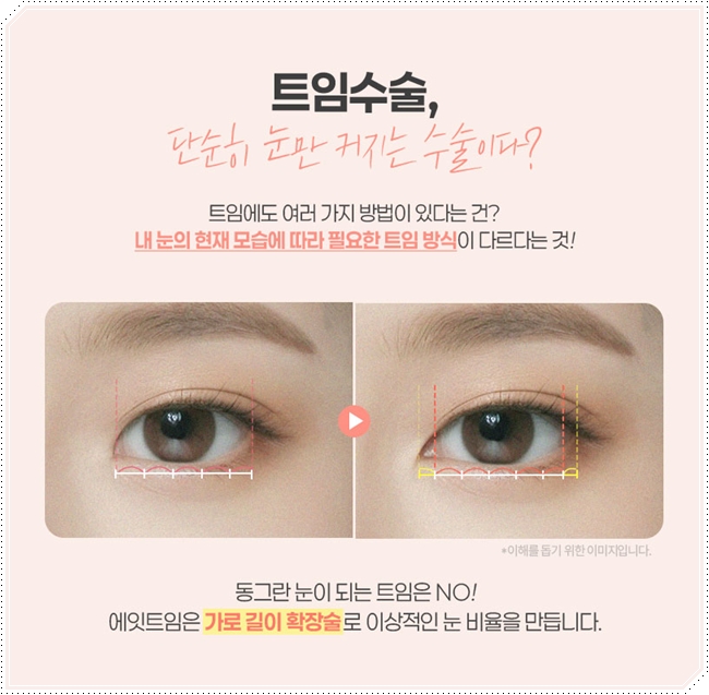 내 눈에 맞는 앞트임 필요할까? 수술 방법과 대략적인 비용 안내 관련 이미지 6