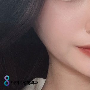 눈성형외과 내게 맞는 눈성형을 찾아요 관련 이미지 15