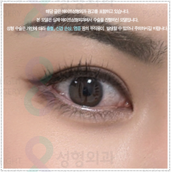 눈 앞트임과 윗트임 준비, 내돈내산 후기를 찾아볼 때 수술 전후 확인할 것 (비용 등) 관련 이미지 3