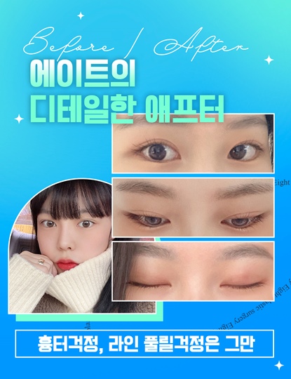 Hospitals That Are Good at Eye Plastic Surgery, Places That Are Good at Double Eyelid Surgery, Gangnam Places Good at Double Eyelid Surgery image 9