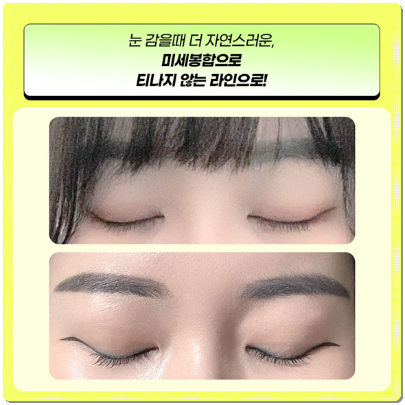 Ptosis Correction Cost: What Are the Criteria for Choosing Non-Incisional or Incisional Surgery? image 9