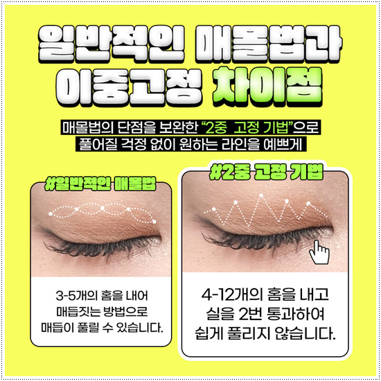 쌍꺼풀 자연유착과 매몰, 절개 사이에서 고민이라면? 비용과 풀림 가능성을 낮추는 수술 방법은? 관련 이미지 7