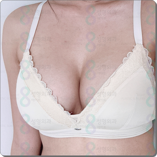 Breast Augmentation Surgery Review: Implants, Recovery Time, and How to Minimize Side Effects image 6