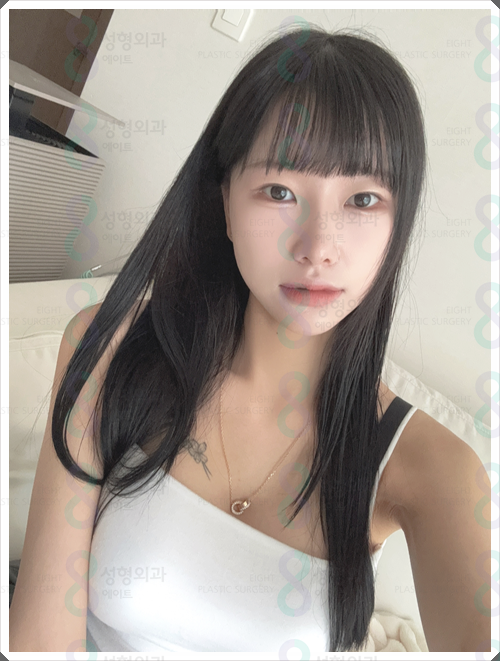 매부리코수술 비용, 왜 병원마다 차이가 날까? 관련 이미지 3