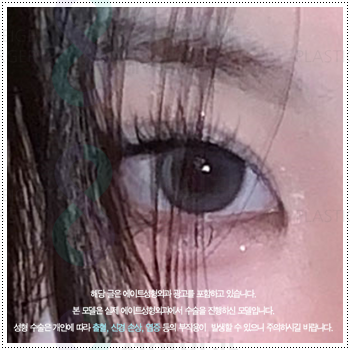 쌍꺼풀 자연유착과 매몰, 절개 사이에서 고민이라면? 비용과 풀림 가능성을 낮추는 수술 방법은? 관련 이미지 5