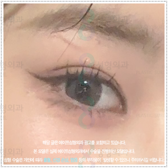 What Are the Prices and Combined Effects of Epicanthoplasty and Upper Epicanthoplasty with Double Eyelid Surgery? From Eye Shape Changes in Reviews of Front-and-Upper Epicanthoplasty to the Differences image 5