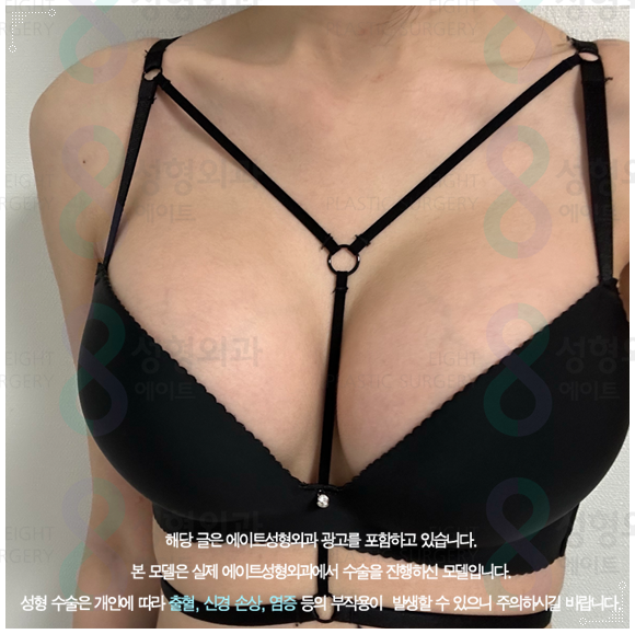 모티바 보형물이 가슴 수술의 가격 차이가 나는 이유? (부작용 증상을 낮추는법) 관련 이미지 2