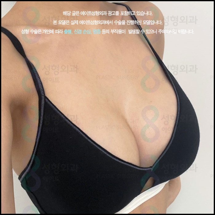 When Can You Exercise After Breast Augmentation, and How Long Is the Recovery Period? A Guide to Safe Recovery image 4