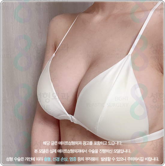 How Much Does Breast Augmentation with Mentor Xtra Cost? What to Know About Feel and Precautions Before and After Surgery image 5