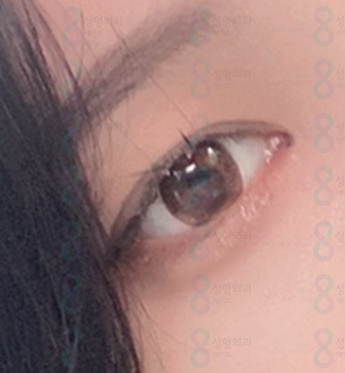 강남 눈매교정잘하는곳 비절개눈매교정전후 가격 차이에 대해서 관련 이미지 2