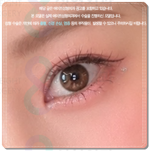 자연유착쌍커플 후기, 쌍수 할 때 재수술 없이 성공하려면? (비용 문의) 관련 이미지 1