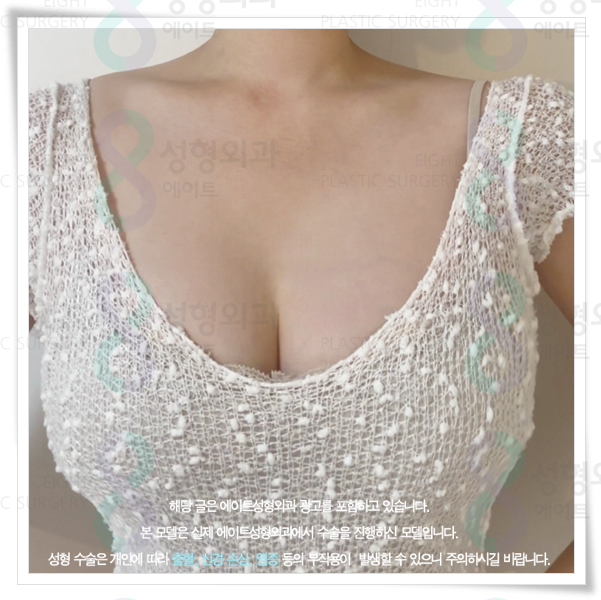 가슴성형 시 사용되는 보형물 종류와 가격 차이는 왜 생기나요? 관련 이미지 2