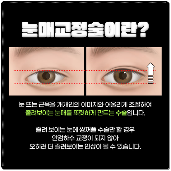 How Much Is a Reasonable Cost for Non-Incisional Ptosis Correction to Escape Sleepy-Looking Eyes? (Including the Differences from Incisional Surgery and Recovery Time) image 10