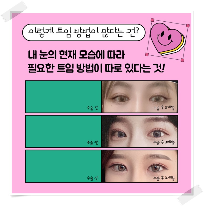 앞트임비용 얼마인지 알아보려면 관련 이미지 2