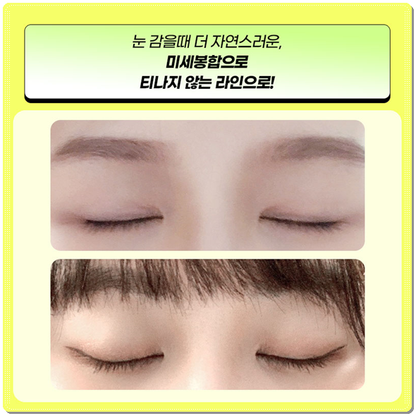 Ptosis Correction Cost: What Are the Criteria for Choosing Non-Incisional or Incisional Surgery? image 6