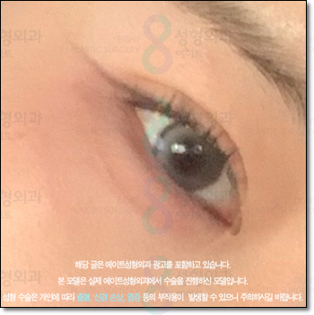 A Review of Upper Blepharoplasty Costs That Was Worth Every Penny! From How to Remove Mongolian Folds to Pricing and Recovery Care Tips image 1
