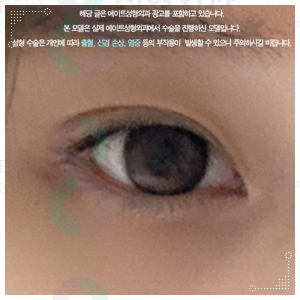 When Can You Wear Makeup After Non-Incisional Double Eyelid Surgery? Including Reviews of Swelling and Loss of the Fold image 5