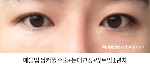 남자눈성형전후 비교해본다면 관련 이미지 5