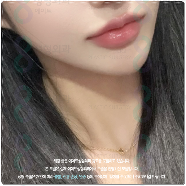 울쎄라 턱살에 효과 언제부터 있나요? (300샷 기준의 가격 평균은?) 관련 이미지 5