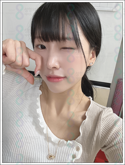 매부리코 수술 비용 후기 정보 총정리 관련 이미지 2
