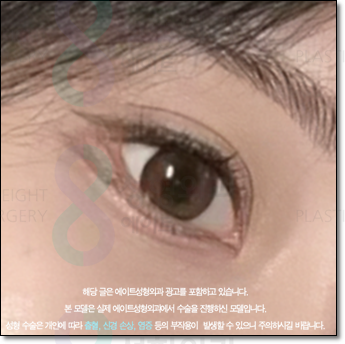 쌍커풀 수술을 고민하신다면? 매몰법의 전후 변화와 비용까지 꼼꼼히 체크하세요 관련 이미지 3